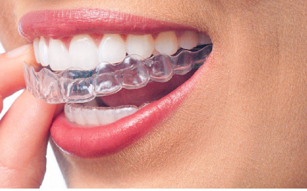 Cette Innovation Va Faire Disparaitre Les Appareils Dentaires En Metal