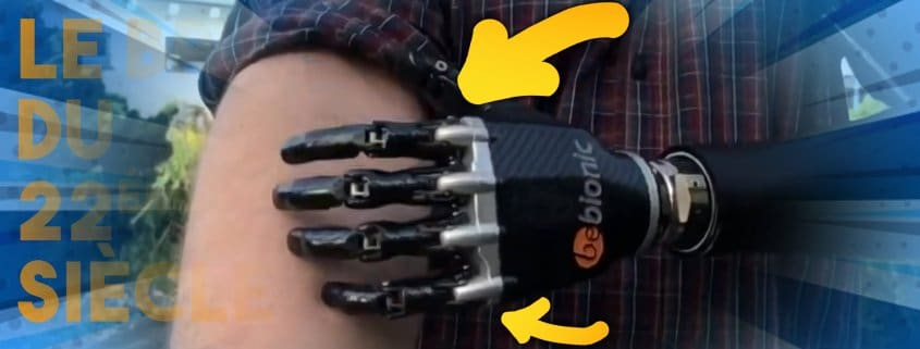 un orthopédiste en allemagne a créé, grâce au scan 3D, un bras bionique contrôlé par la pensée